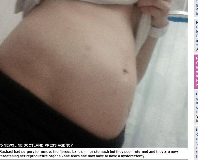 

Rachel conta que seus problemas começaram em abril deste
ano. Seu estômago inchou tanto durante uma noite e ela foi levada às pressas ao
hospital. Desde então, tem passado por vários exames