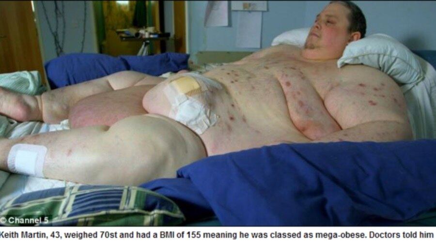 

Com obesidade mórbida, Keith
Martin, que chegou a pesar 444 kg, fará mais uma tentativa para perder peso e sobreviver. Ele se prepara para passar por uma cirurgia de redução de estômago e, então, retomar sua vida. Hoje, ele não consegue se levantar e conta com uma equipe
de cirurgiões, médicos, enfermeiros, fisioterapeutas e educadores, de acordo com o Daily Mail desta terça-feira
(22)

Maior obeso do mundo emagrece e precisa tirar 50 kg de pele em cirurgia
