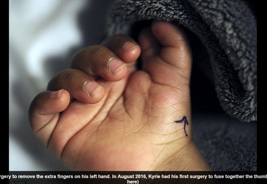 Kyrie Carter já havia passado por um procedimento para amputar os dedos adicionais da mão
esquerda