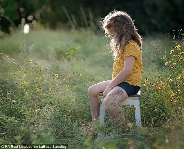 Após dois meses de visitas e diálogos, cirurgiões fecharam uma das veias adicionais da perna de Cambree para tentar abrandar o fluxo de sangue. Em abril de 2015, a menina começou a ser monitorada por um ultra-som. Ela passou por um tratamento a laser para endurecer a pele na perna e escleroterapia para matar algumas veias menores. 

Em setembro de 2015, ela voltou a ser submetida à terapia a laser, e passou por uma cirurgia para remover três veias extras e um par de coágulos sanguíneos não-vivos que ameaçavam sua vida. Seus pais criaram uma angariação de fundos para check-ups anuais em Boston e para que ela possa passar por uma nova cirurgia para fechar a veia adicional e reduzir suas chances de desenvolver um coágulo sanguíneo fatal

