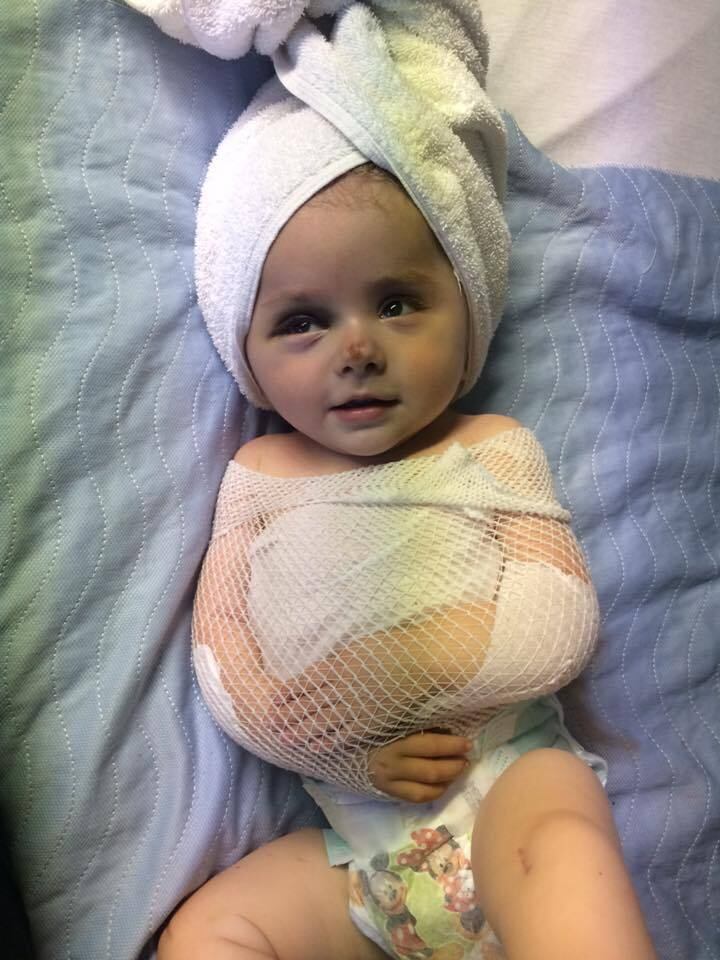 Zoe Lush, da Califórnia, teve os primeiros ossos quebrados
ainda no útero e antes do primeiro aniversário já havia quebrado mais de 100
ossos