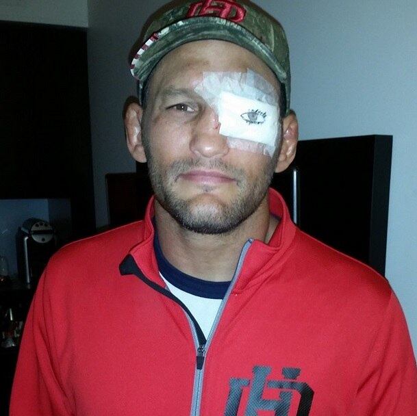 Em sua última luta no UFC, na qual foi derrotado para Gegard Mousasi, o americano saiu com o olho bem roxo, e precisou tapá-lo. Claro que ele aproveitou para brincar da situação