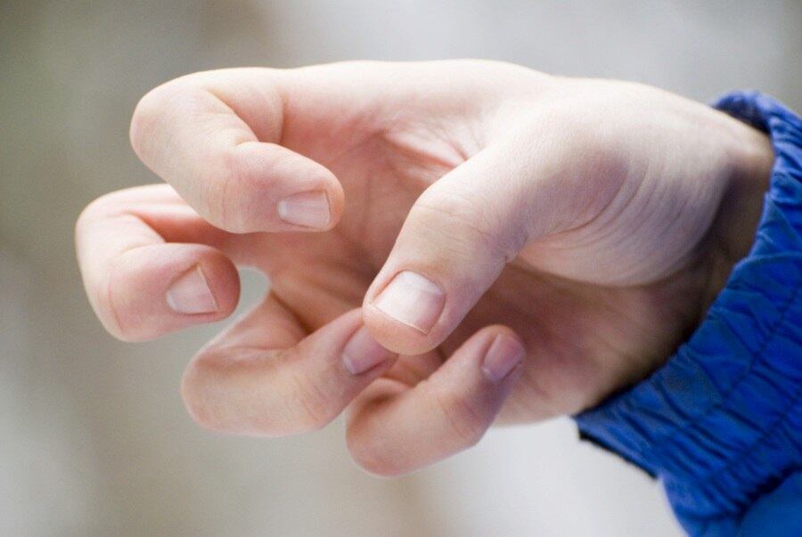 Toda convulsão significa epilepsia. MITO

A convulsão é uma crise epilética na qual existe abalo motor, mas o sintoma só pode ser considerado epilepsia se ocorrer com frequência. Por isso, a medida mais eficaz é procurar um médico para que exames neurológicos sejam aplicados e os resultados sejam precisos

