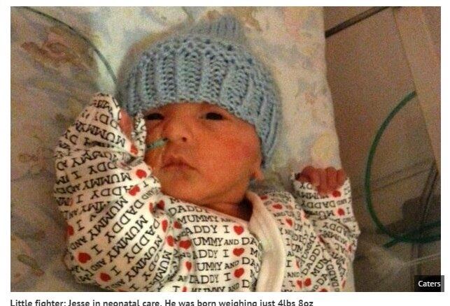 Este pequeno bebê desafiou todas as estatísticas médicas,
que acreditavam que, assim como havia acontecido no passado com sua irmã, ele
também não sobreviveria à gestação. Mas Jesse, um garoto forte e que vem sendo
chamado de “bebê milagroso”, aguentou dentro da barriga de sua mãe após receber
uma ajudinha dos médicos — ele foi costurado ao útero, para evitar que ele “caísse”
lá de dentro 