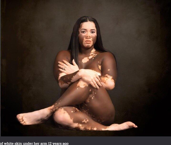 Aos 25 anos, Iomikoe estava com medo de sofrer bullying por ter duas cores de peles diferentes, já que na infância, ela sofria preconceito por ser negra. Por causa disso, a modelo tentou tirar a própria vida