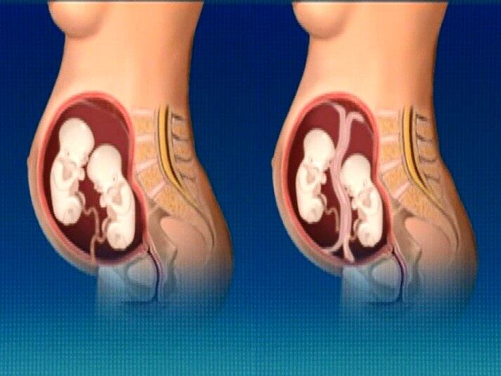 Se os gêmeos nascerem do mesmo óvulo (à esquerda), eles serão idênticos, terão o mesmo sexo e aparência, além de o DNA igual. A única diferenciação que pode ser feita entre os irmãos nascidos desse tipo de gravidez é pela impressão digital, que é única para cada um. Já na gestação de gêmeos parecidos, porém diferentes, cada embrião se desenvolve em um óvulo, por isso, os irmãos podem nascer de sexo e aparência diferentes
