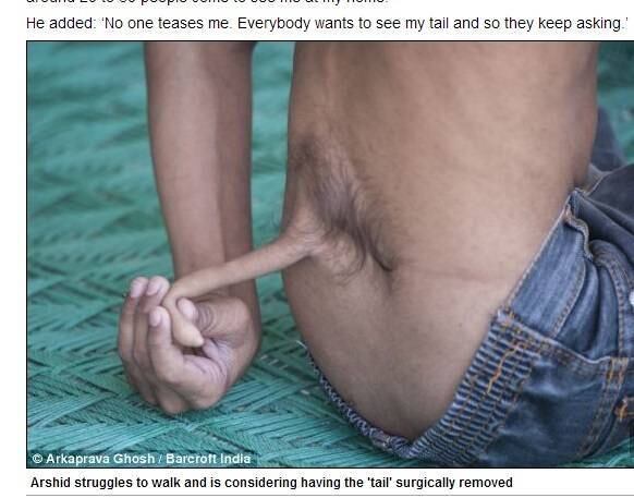 Arshid Ali, de 13 anos, tem uma doença não diagnosticada que
fez com que ele nascesse com uma “cauda”. Por causa da condição, Ali não
consegue andar e vive preso a uma cadeira de rodas. Apesar de todos seus
problemas, ele é considerado pelos indianos a reencarnação de um deus hindu. As informações
são do site DailyMail