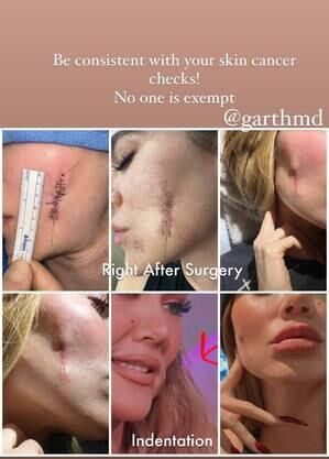Khloé Kardashian publicou as etapas de seu melanoma