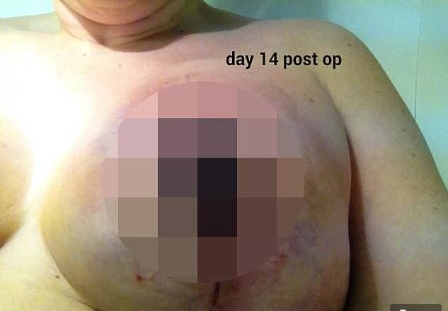 Depois de novos exames, Laura descobriu que seus seios
estavam começando a necrosar. Com medo, Laura perdeu seus mamilos logo de cara,
já que eles já haviam necrosado.
— Nunca havia ouvido falar em necrose antes. Estava com
muito medo e o cirurgião veio até mim e disse, tranquilamente, que isso nunca
havia acontecido com ele