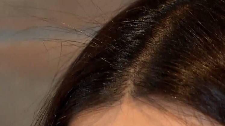 Uma pesquisa feita em três países revelou que a queda acentuada de cabelos está entre os cinco principais sintomas de quem teve covid-19. O estresse causado pela pandemia também tem contribuído para a perda dos fios. O Fala Brasil mostrou pessoas que optaram por um transplante capilar; confira
