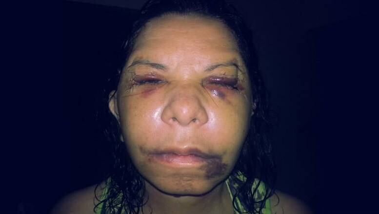 Conhecida como “Rainha dos Caminhoneiros” em Cascavel, no Paraná, a apresentadora de TV, Edileuza Fabrini, de 65 anos, vive hoje um pesadelo: ter que conviver com seu rosto deformado após erro médico em uma cirurgia plástica. Emocionada, ela conta que depois da operação malsucedida, sua vida se transformou completamente.
Além de problemas de saúde, ela foi obrigada a largar o comando do programa de TV que fazia “há 32 anos consecutivos”, como ela mesma faz questão de enfatizar