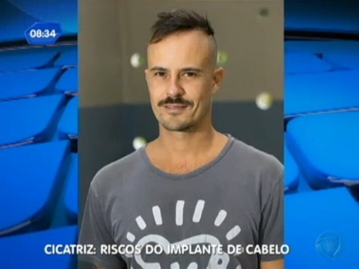 Nas redes sociais o ator declarou: "Ganhei a cicatriz, mas não ganhei o cabelo"
+ Implante capilar: conheça os riscos do procedimento