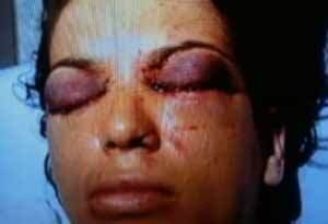 Mulher foi atacada pelo ex-marido no fim de agosto, em Goiânia