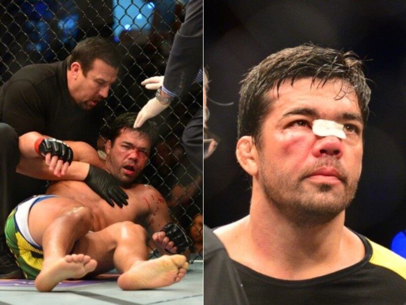 Lyoto Machida não viveu uma boa fase no UFC em 2015. Além de perder a segunda luta seguida no octógono mais famoso do mundo, o brasileiro sofreu com os fortes golpes do cubano Yoel Romero e ficou com o rosto desfigurado. O brasileiro teve até que passar por uma cirurgia para consertar os danos

