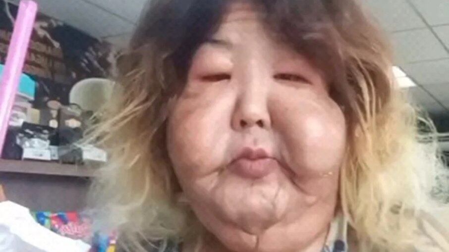 Juju do Pix enfrenta as sequelas de um procedimento feito em 2017