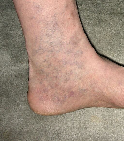 

Ivanésio Merlo explica que há três níveis diferentes de
varizes. As microvarizes, espécie de “aranha na região da perna”. As
reticulares são um pouco maiores do que estas. E a ultima categoria são as
varizes mais grossas e volumosas que chegam a formar caroços no corpo.

 — Nestes casos mais graves, tem que ser feito cirurgia.

