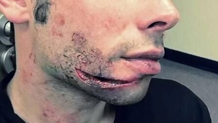 Gary Fawcett, jogador de futebol amador na Inglaterra, teve seu rosto aberto enquanto estava deitado no chão após sofrer uma falta. O responsável pelo acidente foi um adversário que passou as travas da chuteira no rosto do jogador que ainda estava no chão. Gary precisou de 30 pontos para fechar o corte de aproximadamente 6 cm

