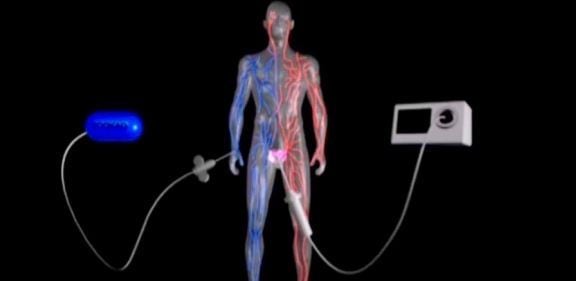 Medicamento aplicado pela veia é ativado por fibras óticas na próstata