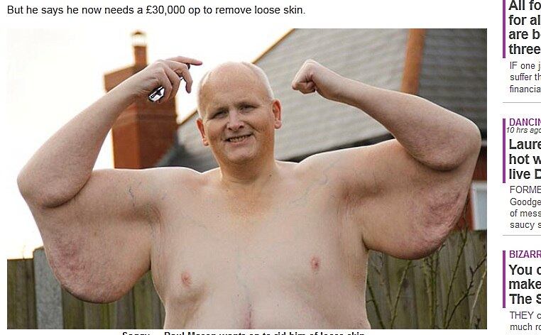 De acordo com uma publicação do jornal, a grande quantidade de pele solta está por toda parte do corpo de Mason: nos braços, sobre a barriga e em volta das coxas, fator que causa infecções constantes. O britânico conta que é obrigado a usar uma cadeira de rodas para se locomover na maior parte do tempo.

— É como se eu estivesse carregando algumas crianças por ai