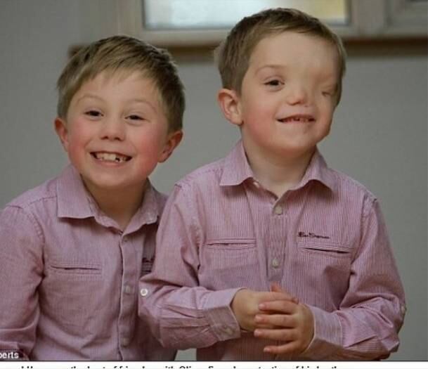 Para a maioria das mães, o momento de ver o filho após o parto é o mais esperado. Mas não foi assim para Charlene Machin. A mãe, de 33 anos, deu à luz os gêmeos Oliver e Harry, mas um deles nasceu com metade do rosto deformado. Harry passou por três cirurgias para reposicionar sua órbita ocular e, em julho do ano passado, foi realizada uma operação de dez horas para remover a frente do seu rosto e do crânio com o objetivo de reposicionar o cérebro