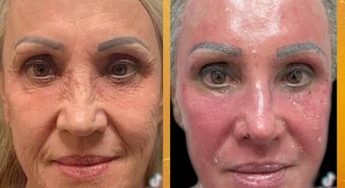 Antes e depois do peeling viralizou nas redes sociais