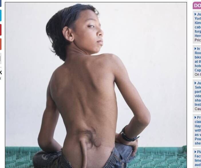 Outros médicos afirmam que o “rabo”, que hoje mede 18 cm, é a causa da paralisia.
Segundo os especialistas, o jovem indiano tem uma doença chamada espinha bífida. O problema faz com que membranas cresçam entre os orifícios das vértebras, o que pode conduzir
à uma paralisia parcial

Mãe implora ajuda médica para filho que nasceu com "cauda"

