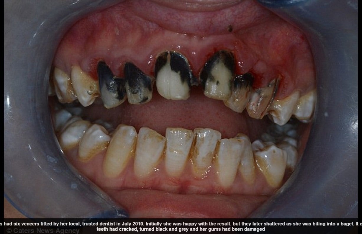 De acordo com a publicação, Faye sempre sofreu bullying na escola por causa da
coloração de seus dentes. Prestes a se casar, a mulher estava feliz que o
problema havia desaparecido, porém, quando ela
foi comer um pão, o esmalte de seus dentes voltou a desmanchar, e a jovem
descobriu que o problema era muito pior do que ela imaginava.
— Todos os meus
dentes estavam pretos, com aparência de estragados. Eu fiquei desesperada. Só conseguia pensar em quão pretos estariam meus dentes na foto do casamento.
Foi horrível