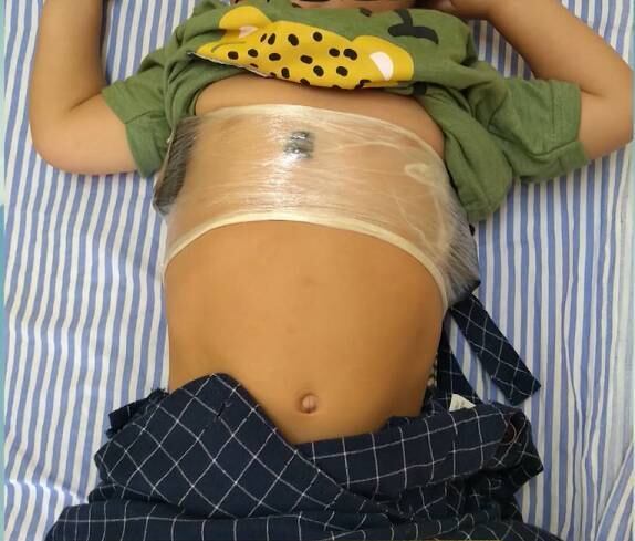 Itens estavam presos no corpo de criança de um ano