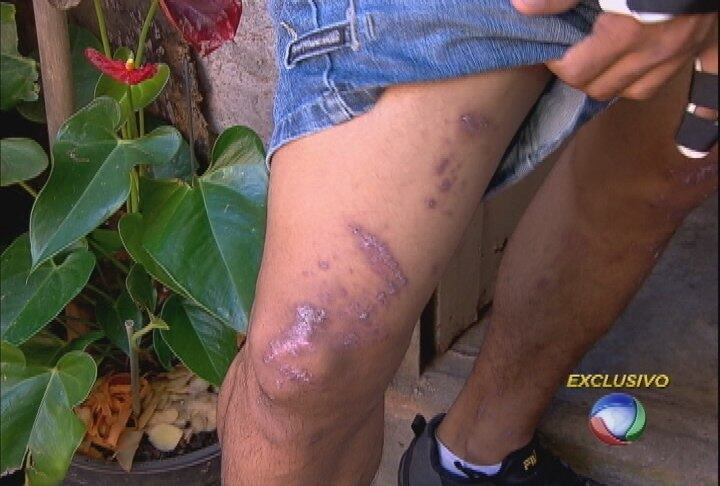 David sente uma forte dor no braço. Ele levou mais de
280 pontos pelo corpo e tenta aceitar uma nova e difícil realidade. A boa
notícia é que ele ganhou um braço mecânico de alta tecnologia.