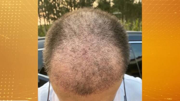 O número de pessoas que optam por realizar essa cirurgia aumentou durante a pandemia do coronavírus